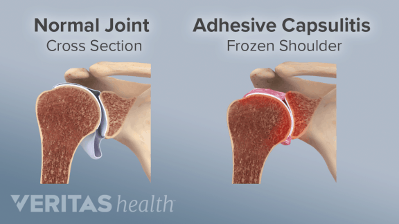 Frozen Shoulder / Adhesive Capsulitis - Hohman Rehab and Sports Therapy