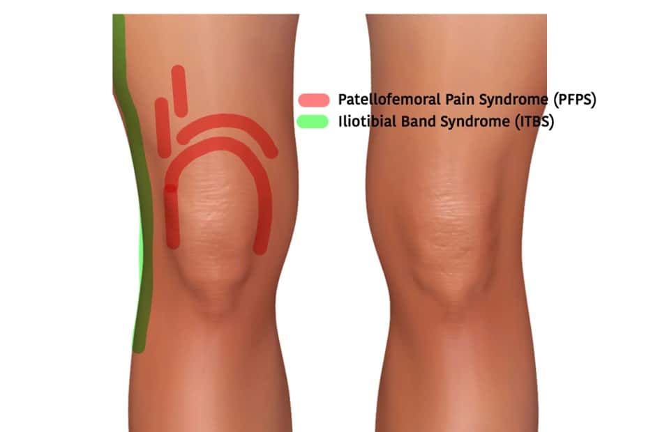 Runners Knee (also known as) ITB Syndrome - Do You Have It and How Do You  Treat It? - Pea Green Physio