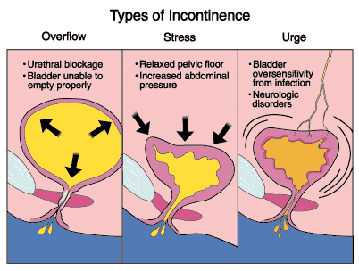 Overflow on sale urinary incontinence