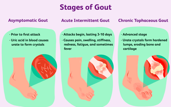 classic presentation of gout