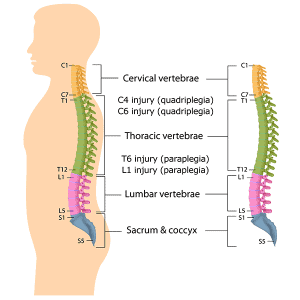 Spinal Cord Injury Quadriplegia