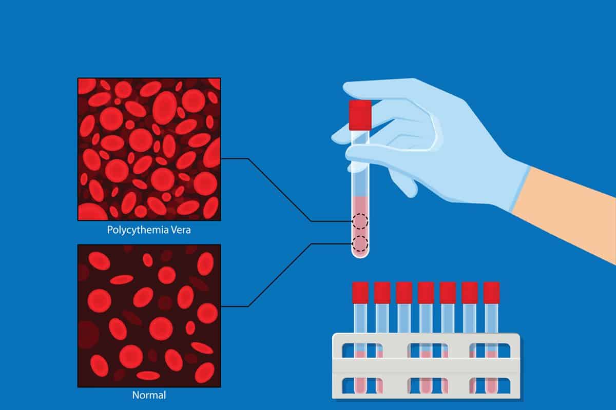 Polycythemia or Too Many Red Blood Cells