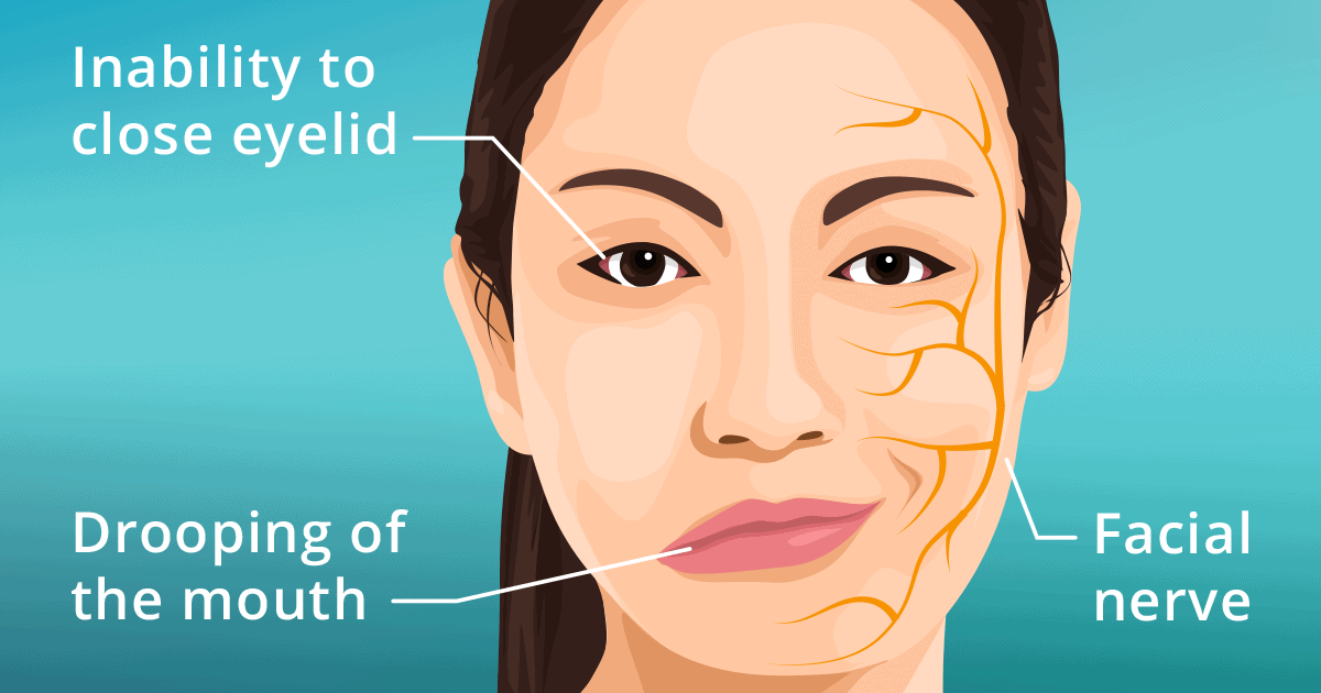 Electrical muscle stimulation for bell's palsy 