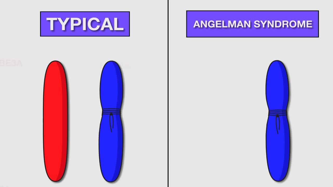 angelman syndrome chromosome