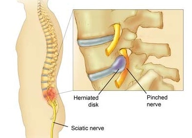 pinched nerve numbness in arm