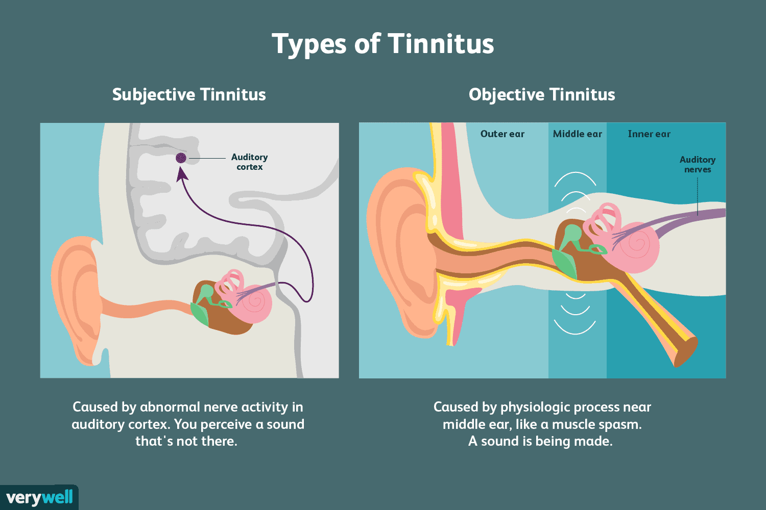 How to Get Relief From Tinnitus: All About Diagnosis and Treatment |  Everyday Health